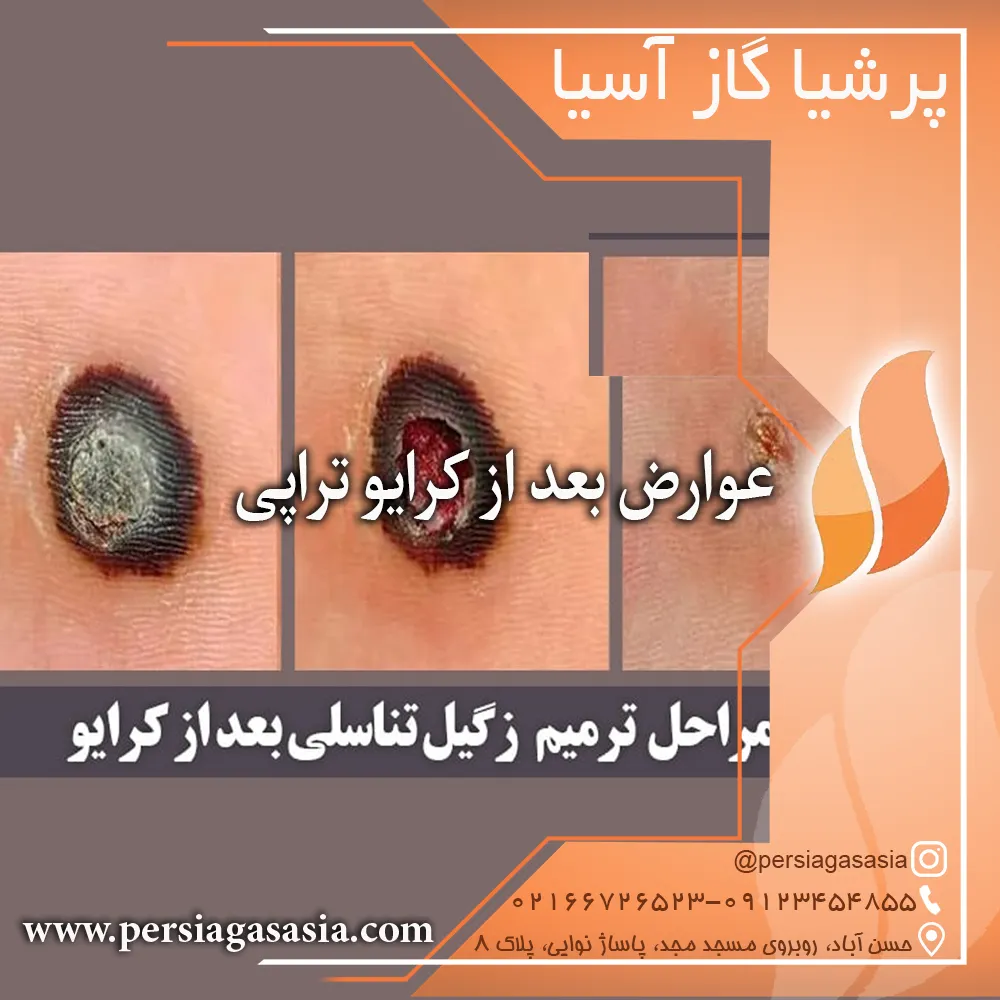 عوارض بعد از کرایو تراپی