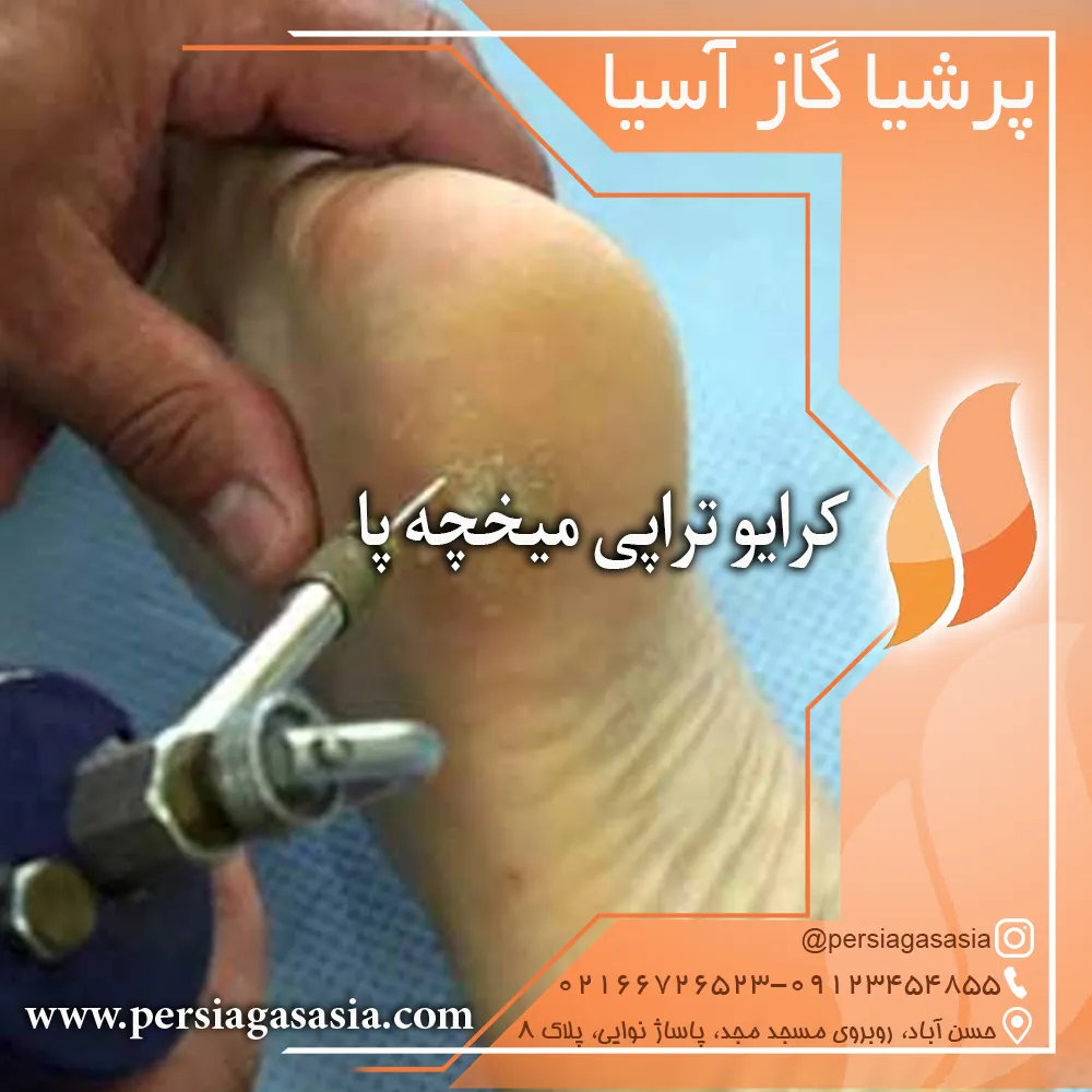 کرایوتراپی میخچه پا